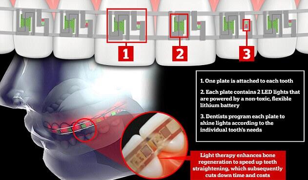 smart brace